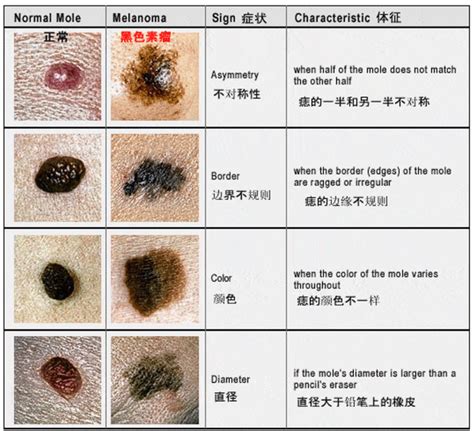 乳房長痣|胸部突然長痣是癌症的症狀